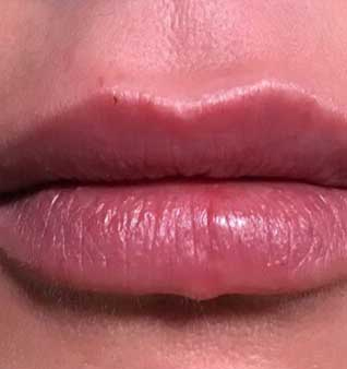 Lips after dermal filler Treatment