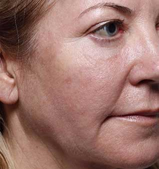 face after Volumizing fillers treatment oakville